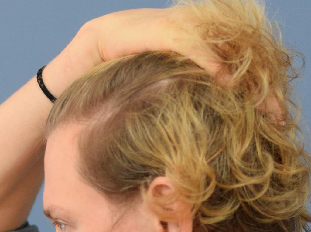 קורונה ורפואת עור: על נשירת שיער